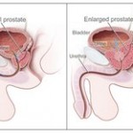 Enlarged prostate prostatic hyperplasia