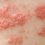 Photograph of shingles zoster outbreak
