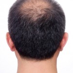 Male pattern baldness alopecia acupuncture treatment