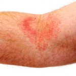 Eczema dermatitis on inner elbow