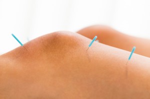 knee receiving acupuncture