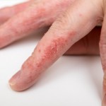 Hand eczema pompholyx cheiropompholyx eczema