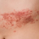 Herpes zoster shingles outbreak on the stomach abdomen