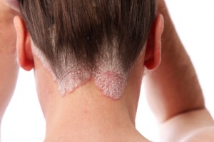 psoriasis on the scalp and hairline