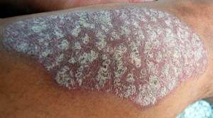 psoriasis white scale lesion arm purple skin