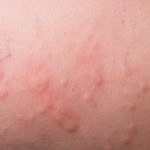 Urticaria Hives on the Skin