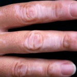 Vitiligo affecting the hand and fingers