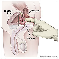 Prostatita venoplant