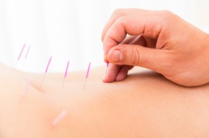 Acupuncture needles treatment on the back