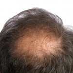 pattern baldness alopecia hair loss
