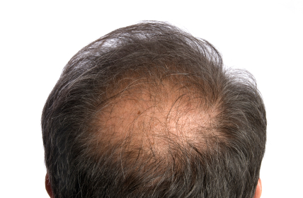 Acupuncture for Alopecia - Jinhee Yoo Acupuncture